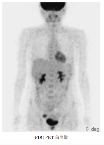 FDG normal ovary