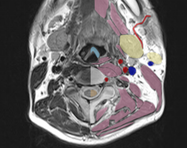 neck MRI normal anatomy