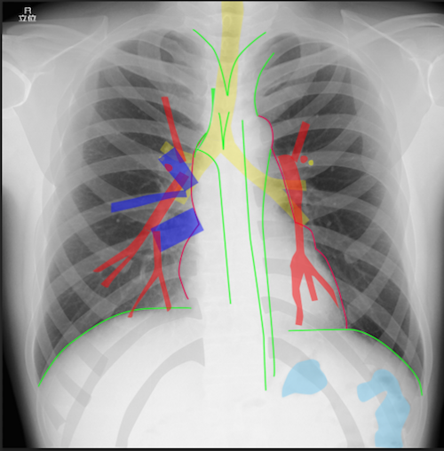 胸部X線の正常解剖ツール！