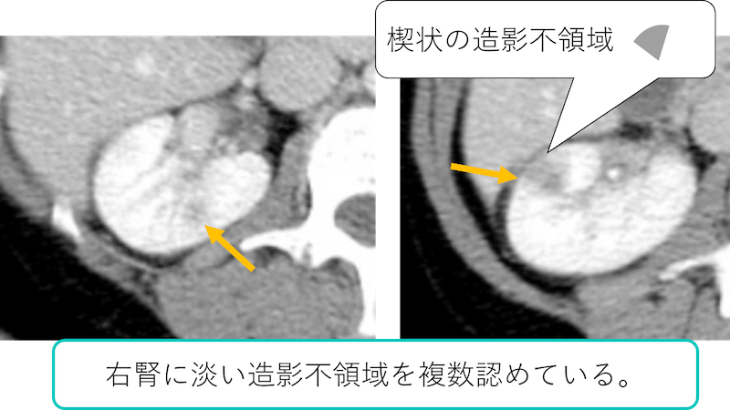 腎盂腎炎のCT画像