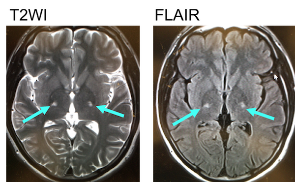 ALS mri findings