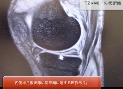 meniscal lesions of the knee