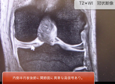meniscal lesions of the knee1