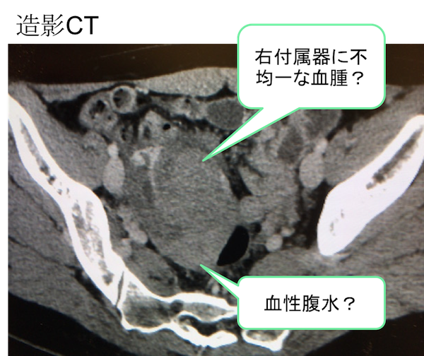 rupture of ovary Ct findings