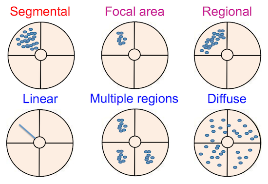 Distribution pattern
