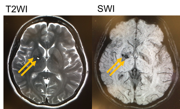chronic cerebral hemorrhage MRI findings