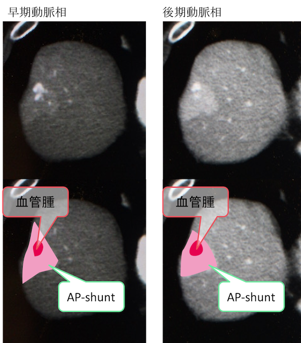 hepatic-hemangioma-with-AP-shunt-CT-findings
