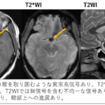 下垂体卒中とは？画像診断のポイントは？