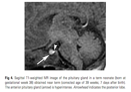 pituitary2