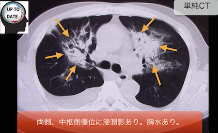 pulmonaryedema