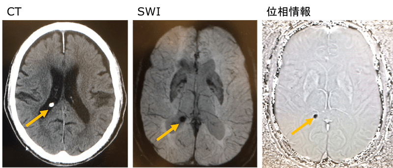 SWIで石灰化のMRI画像