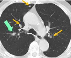 気管支内転移の CT 画像