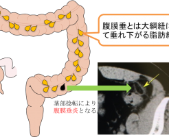 腹膜垂炎の CT 画像