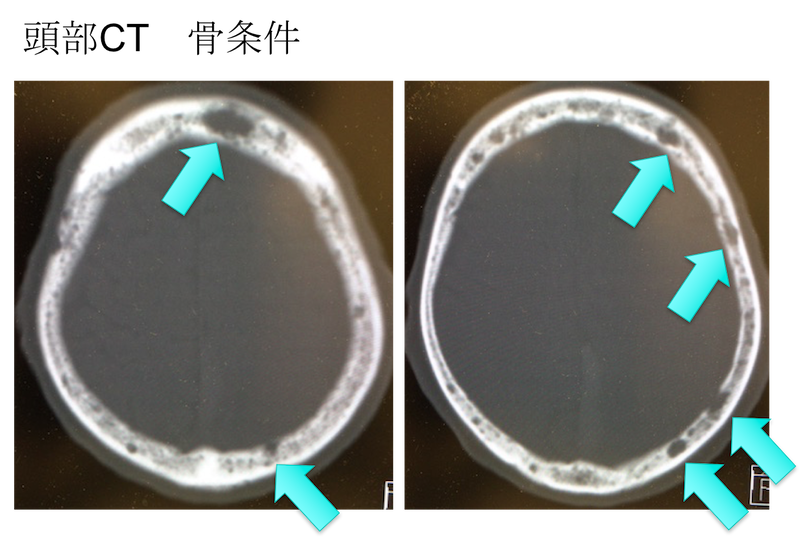 multiple myeloma CT findings punched out lesion