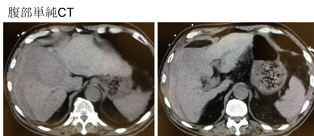 rupture of HCC plain CT findings