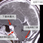 低髄液圧症候群(脳脊髄液減少症)のCT、MRI画像診断