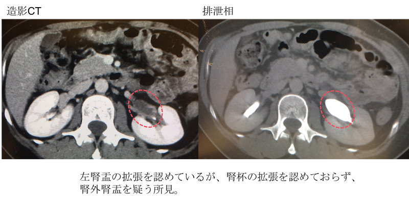 Extrarenal pelvis CT findings