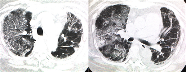 mpa-chest-ct-findings