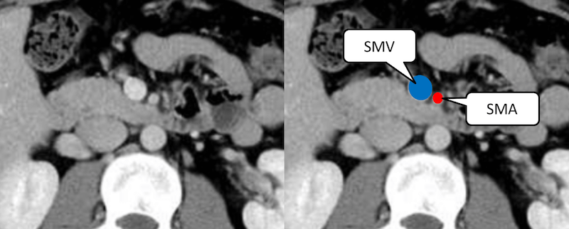 SMA径とSMV径の正常の関係の画像