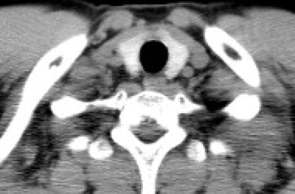 anatomy of thyroid CT finding