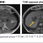 CTやMRI画像で腫瘍内に脂肪(脂質)を伴うことがある肝腫瘍の鑑別診断