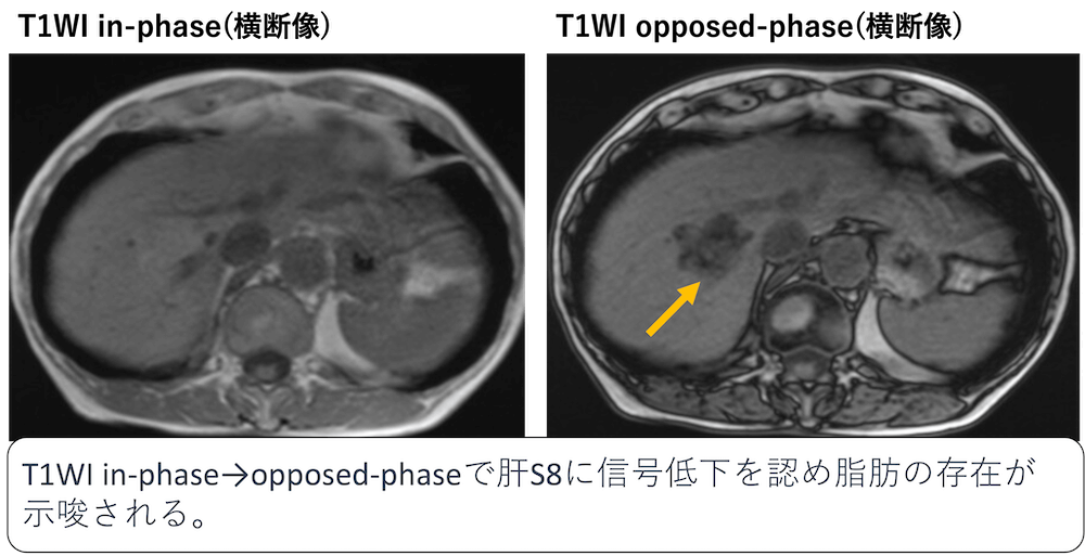 CTやMRI画像で腫瘍内に脂肪(脂質)を伴うことがある肝腫瘍の鑑別診断