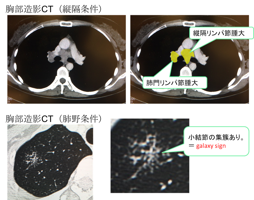 sarcoidosis CT findings