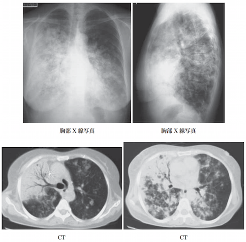 Wegener’s granulomatosis