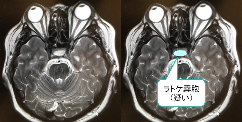 ラトケ嚢胞のMRI画像