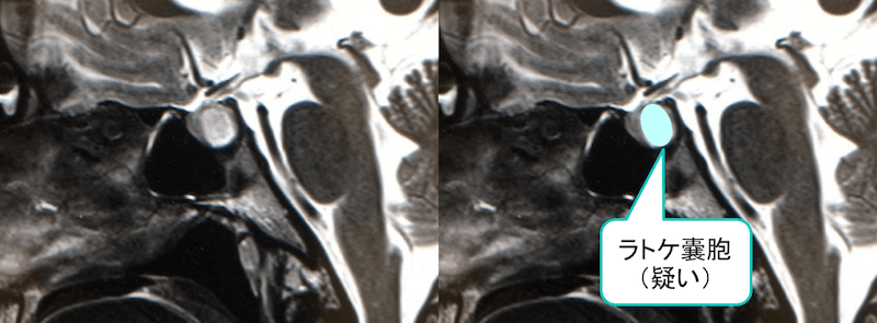 ラトケ嚢胞のMRI画像