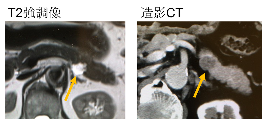 microcystic type of SCN SCT CT MRI findings1