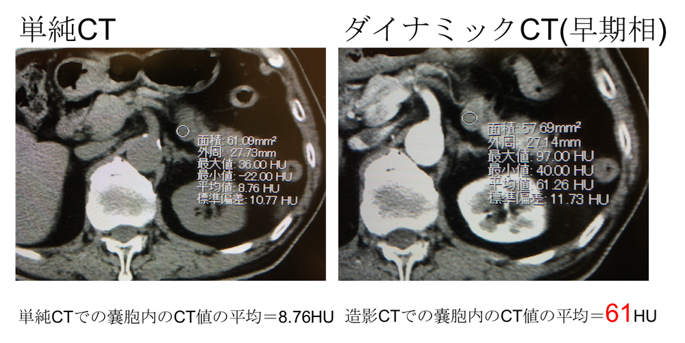 microcystic type of SCN SCT CT MRI findings2
