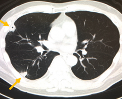 敗血症性肺塞栓の CT 画像