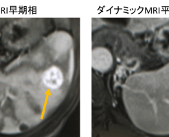 脾臓血管腫のMRI画像