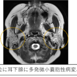 唾液腺疾患 | 歯科国試ドットコム