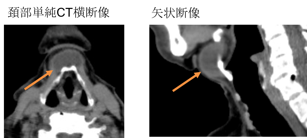 甲状舌管嚢胞(正中頸嚢胞)のCT画像