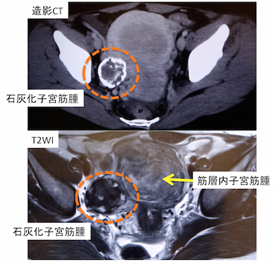 pedunculated abdominal uterine myoma