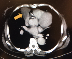 心膜嚢胞のCT画像