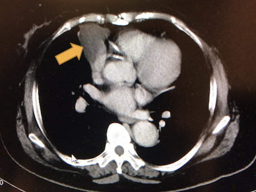 心膜嚢胞のCT画像