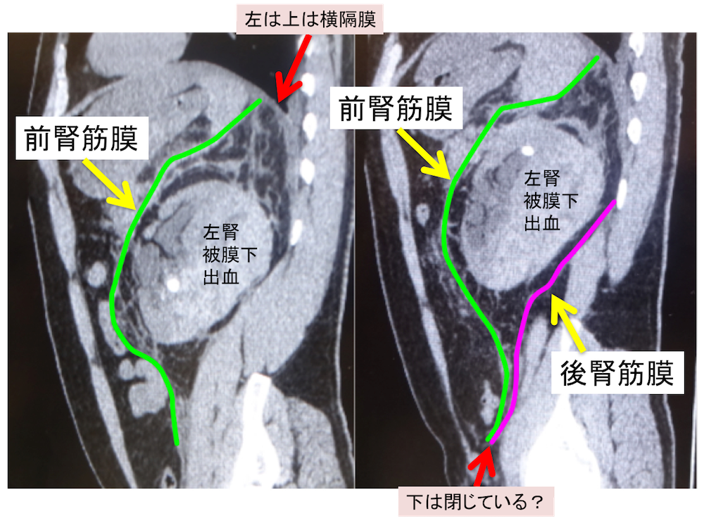 腎周囲腔のCT画像矢状断像
