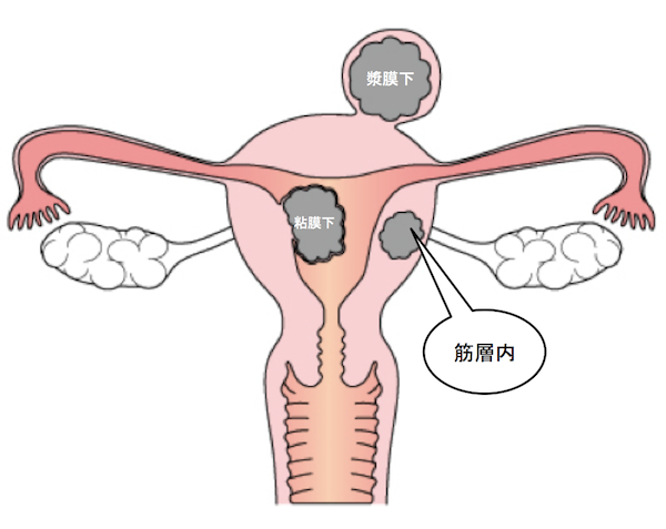 子宮筋腫のMRI画像診断のポイントは？症状、変性、種類は？