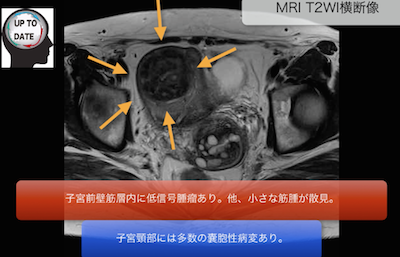uterine myoma1
