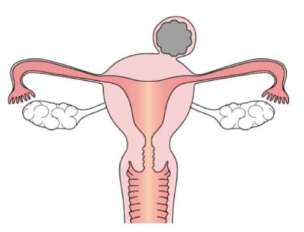 uterine myoma2