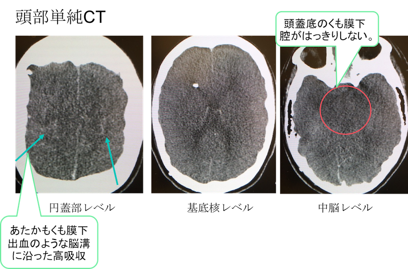 Brain Hypoxia CT findings
