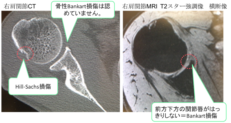 CT and MRI findings of recurrent dislocation of shoulder joint1