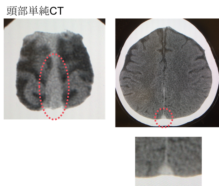 cerebral venous sinus thrombosis plain CT findings