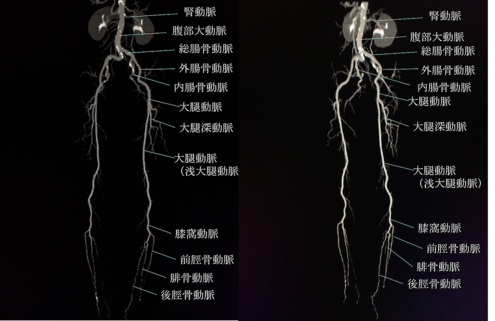 下肢CTAの動脈の解剖