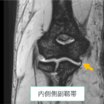関節のMRI【裁断済み】