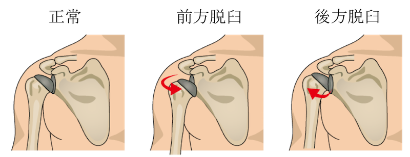 recurrent dislocation of shoulder joint1