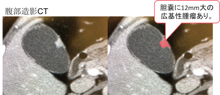 胆嚢癌の CT 画像
